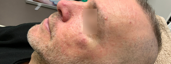 Resultaat Rosacea 4