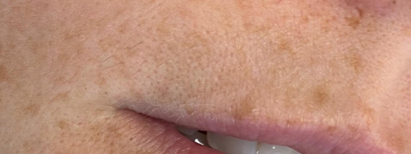 Resultaat Laserontharen Bovenlip2