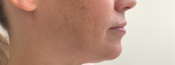 Resultaat Kin Filler En Kaaklijn Filler Vrouw Voor