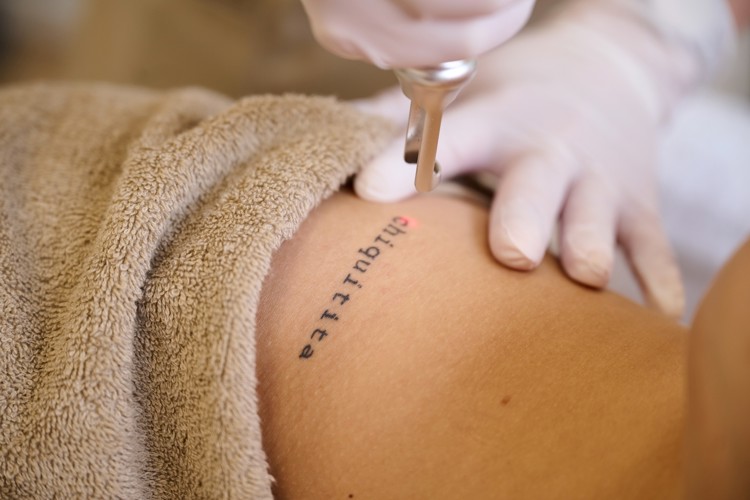 Tattoo Laseren Bussum Jpg