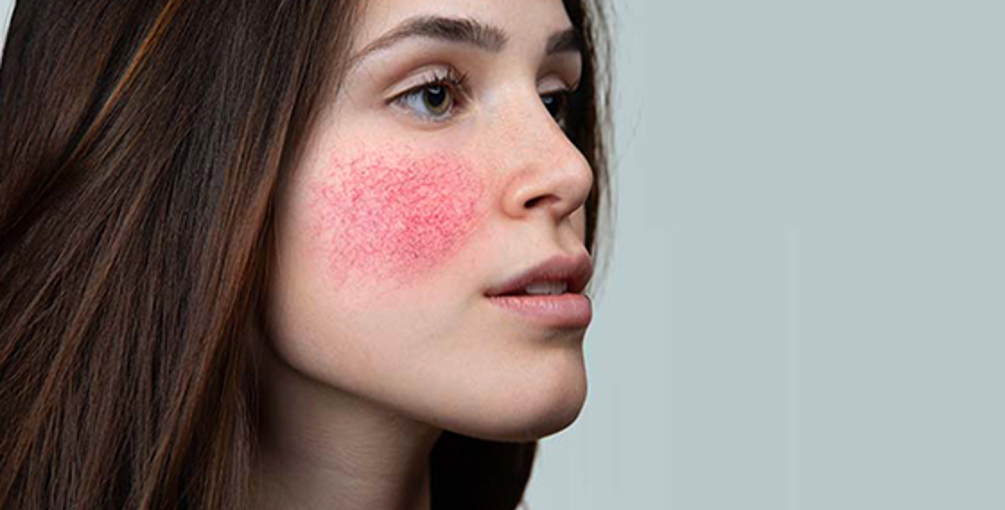 Rosacea behandelen