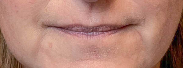 Lipfillers 4 (1)