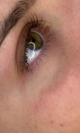 Microneedling Onder Ogen Resultaat 2