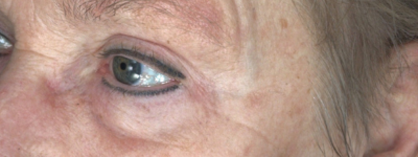 Resultaat Microneedling En Morpheus Na