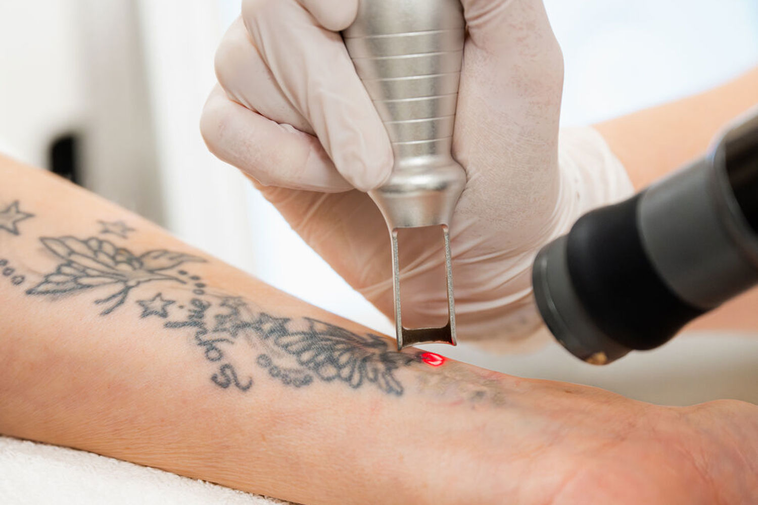 Hoe Werkt Verwijderen Tattoo