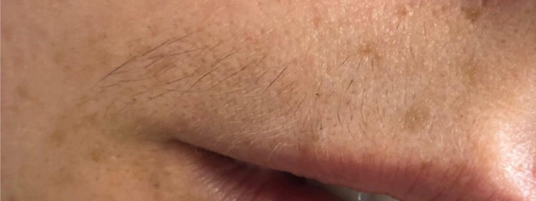 Resultaat Laserontharen Bovenlip