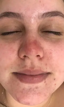 Rosacea Resultaat Na