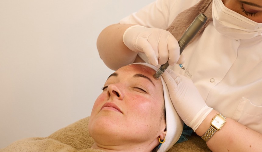 Microneedling Arnhem Zuid