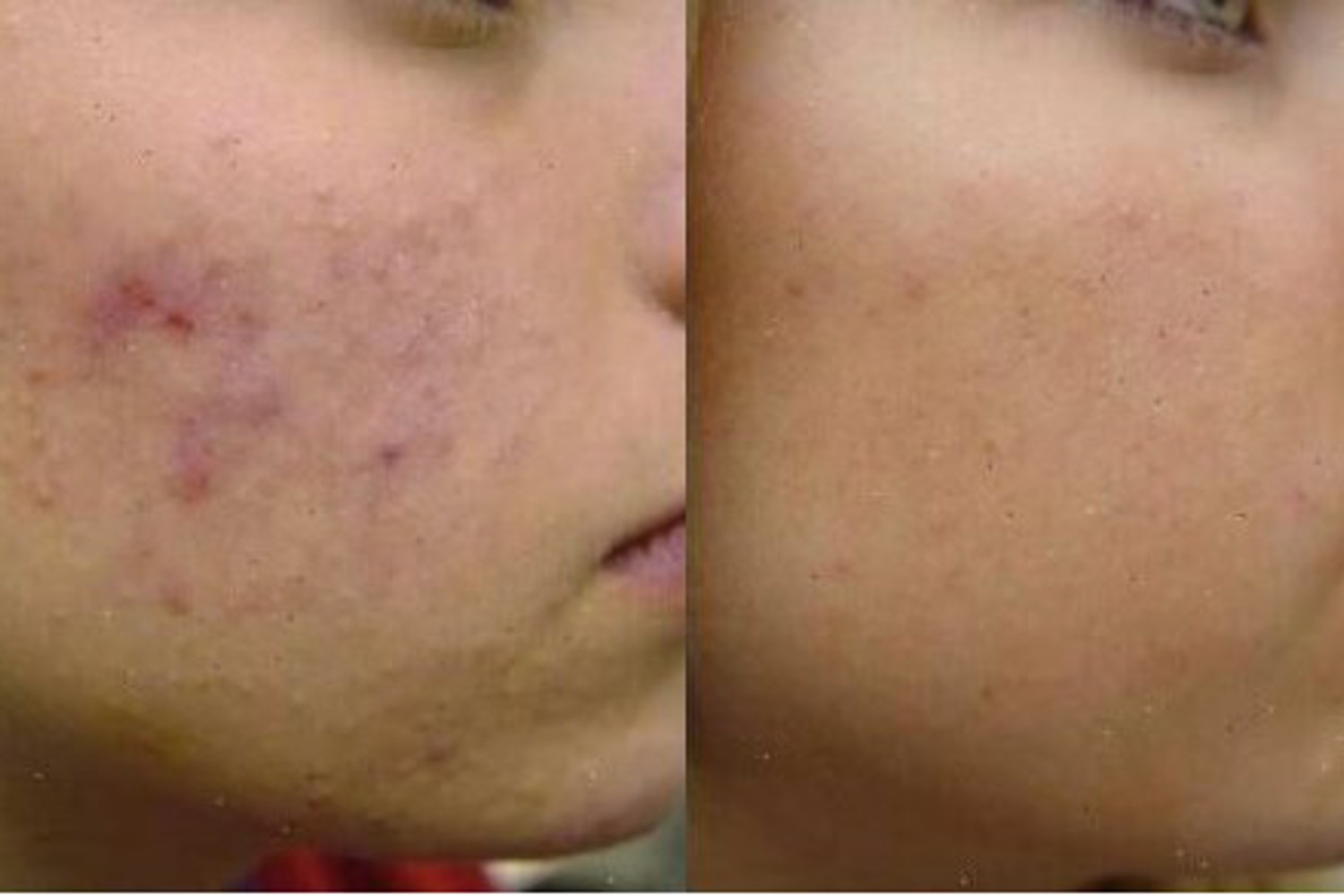 Ervaring Acne Behandeling