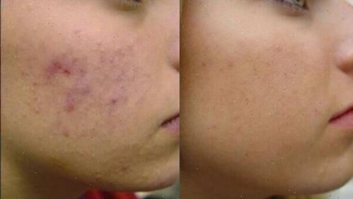 Ervaring Acne Behandeling