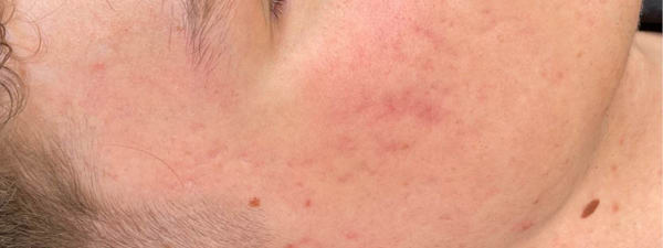 Acne3x2