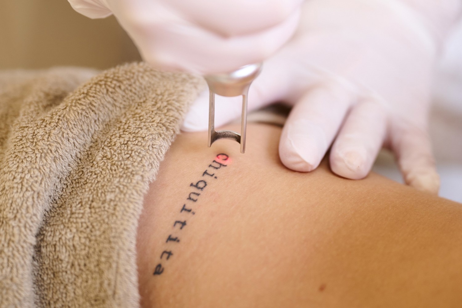 Hoeveel Kost Tattoo Laseren