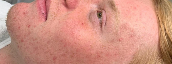 Acne 5X2