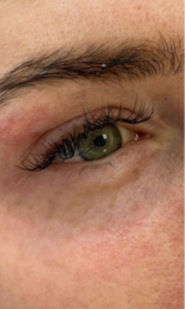 Colorescience Oogbehandeling Resultaat 2