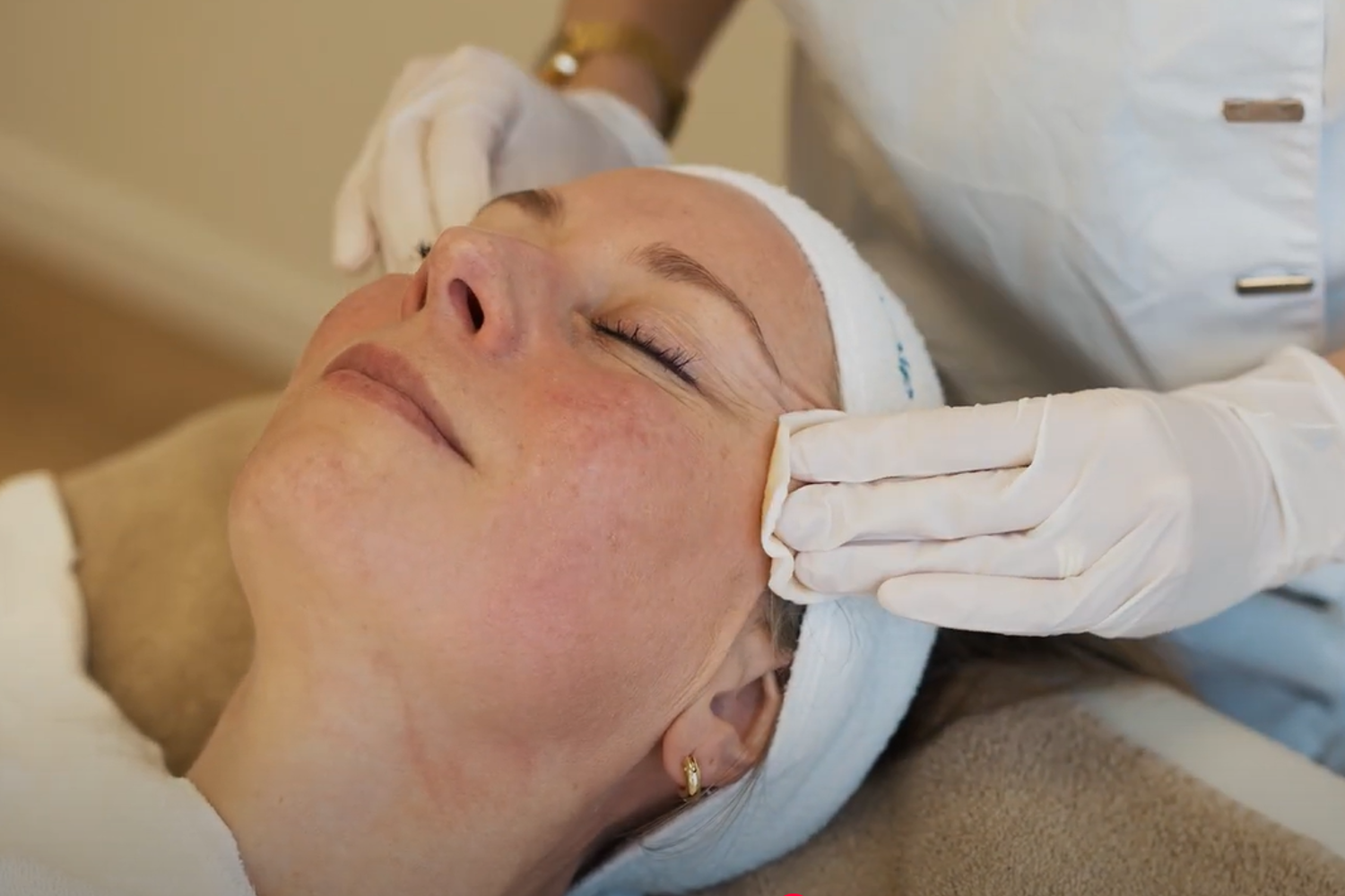 Rosacea Behandeling Ervaring