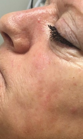 Cosmetique Totale Couperose (3)