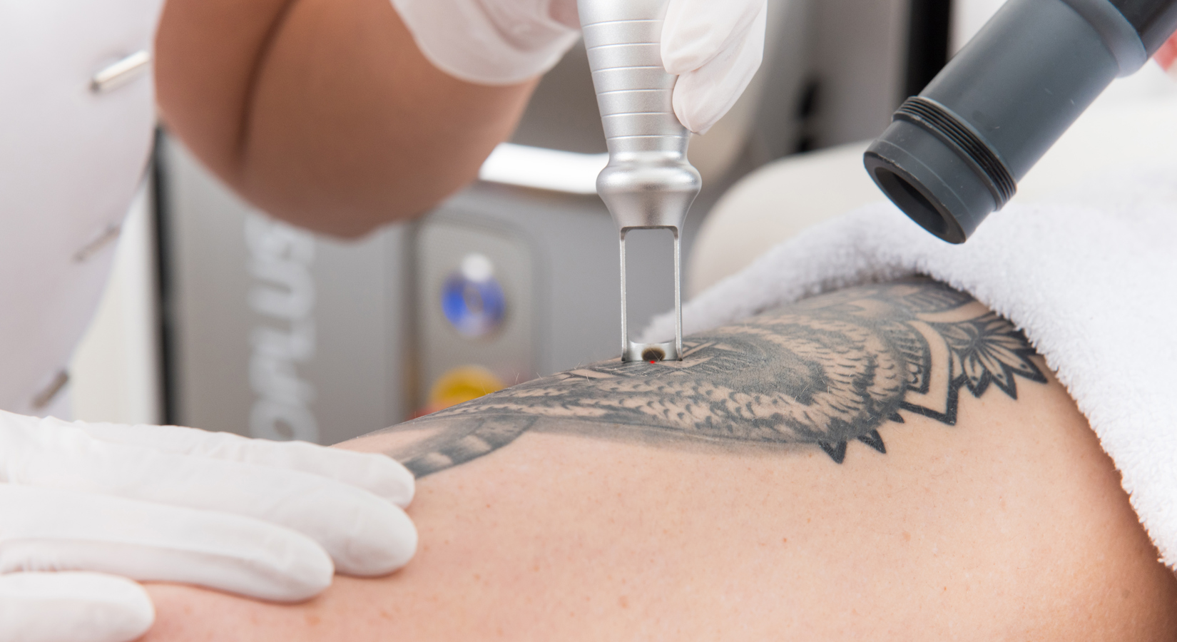 Kosten Tattoo laseren